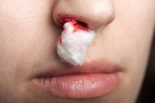 Nasenbluten durch Vitamin-K-Mangel