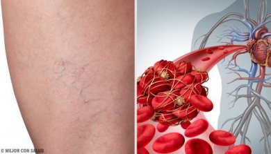 3 Hausmittel gegen Phlebitis