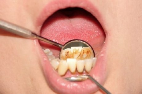 Was tun gegen Zahnstein?