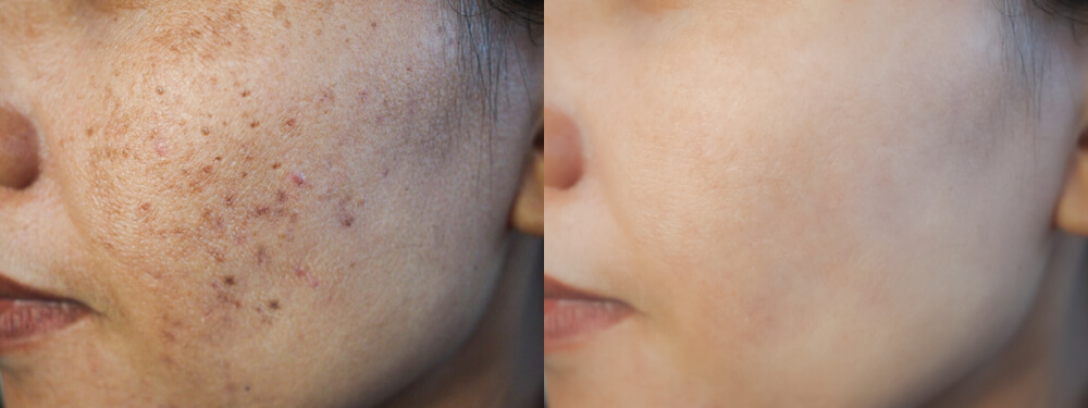 5 Kurkuma Masken Gegen Aknenarben Besser Gesund Leben