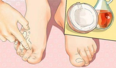 4 Möglichkeiten, Hühneraugen und Hallux valgus loszuwerden