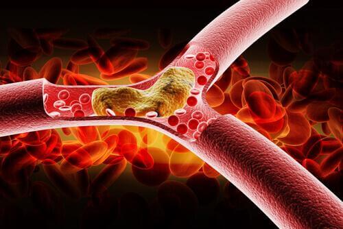 Arterien - hoher Cholesterinspiegel