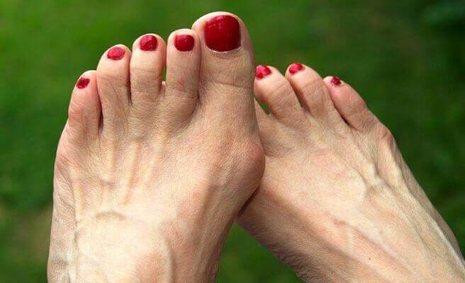 Fußprobleme - Hühneraugen und Hallux valgus