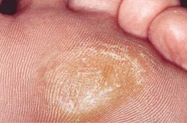 5 natürliche Mittel zur Entfernung von Hornhaut