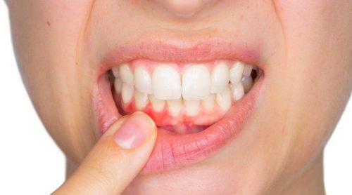 Anzeichen einer Zahninfektion-Eiter