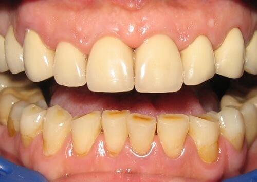 Anzeichen einer Zahninfektion-Entzündung