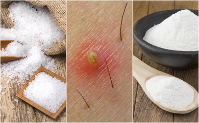 5 natürliche Mittel gegen eingewachsene Haare