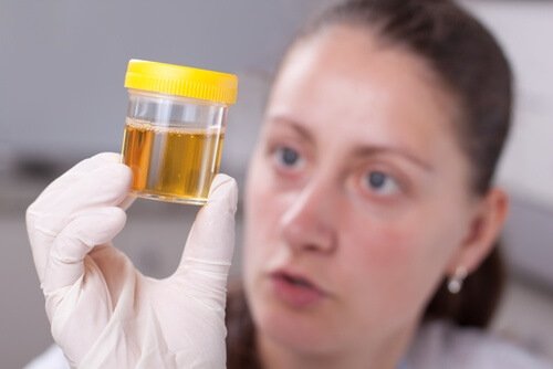 Stark riechender Urin ist eines der Symptome, die auf Nierensteine hinweisen.