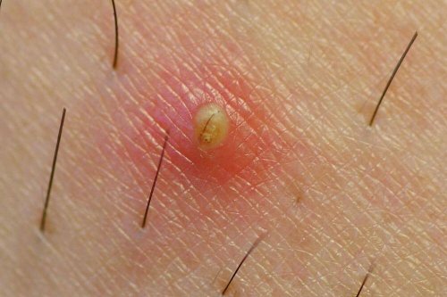 was tun gegen eingewachsene Haare?
