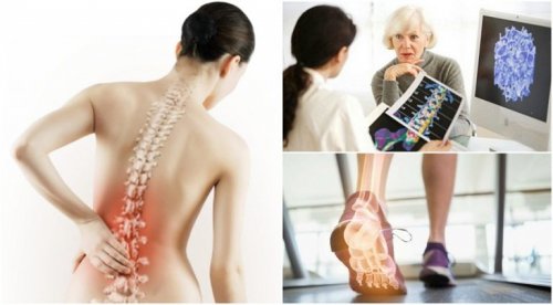 Osteoporose kann Rückenschmerzen verursachen
