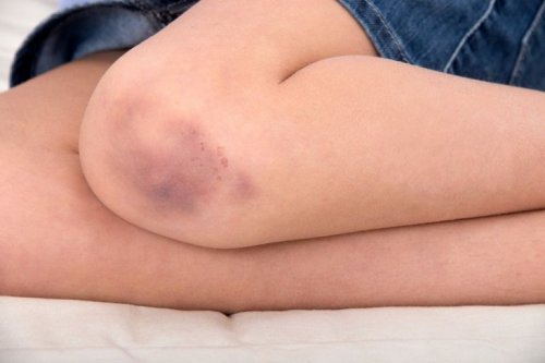 Vaseline als Hausmittel gegen Prellungen 