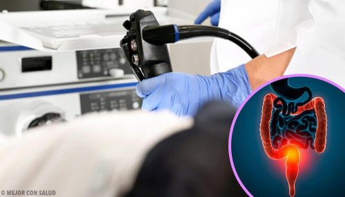 Behandlung von Darmkrebs: alles, was du darüber wissen solltest