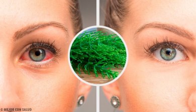 7 Tipps, wie du Konjunktivitis auf natürliche Weise bekämpfen kannst