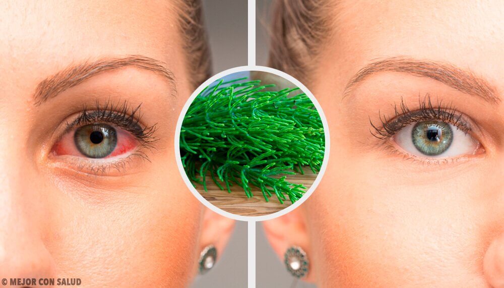 7 Tipps, wie du Konjunktivitis auf natürliche Weise bekämpfen kannst 7 Tipps, wie du Konjunktivitis auf natürliche Weise bekämpfen kannst