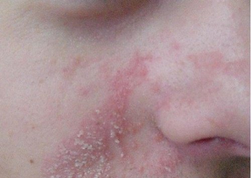 Effektive Naturheilmittel gegen das seborrhoische Ekzem