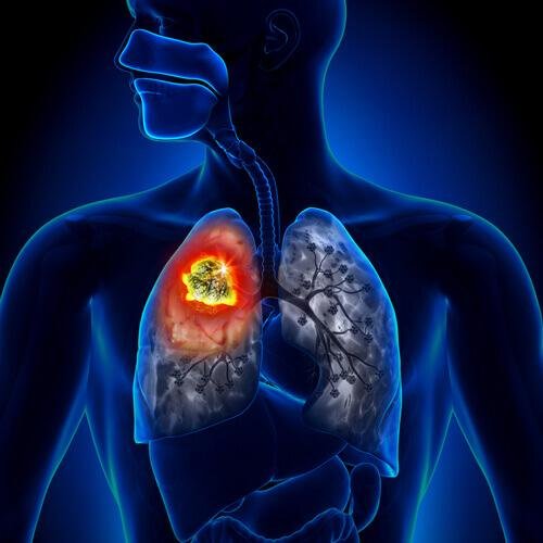 Ursachen von Lungenkrebs sind verschieden
