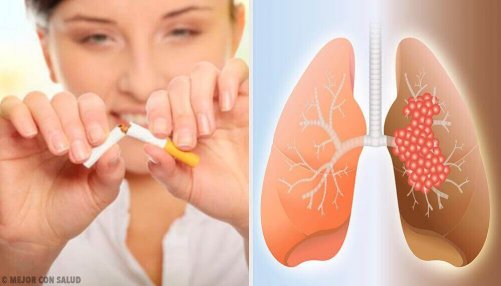 Ursachen von Lungenkrebs, Diagnose und Prävention