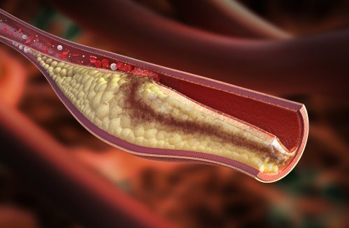 Zitronen-Diät und ihre gesundheitlichen Vorteile: Senkt den Cholesterinspiegel