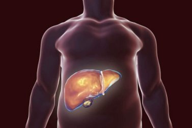 Natürliche Heilmittel zur Entgiftung der Leber