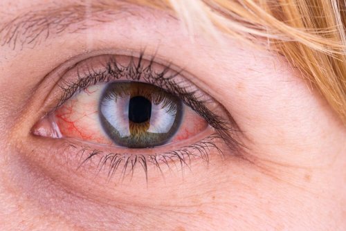 Konjunktivitis auf natürliche Weise bekämpfen mit Hydrotherapie