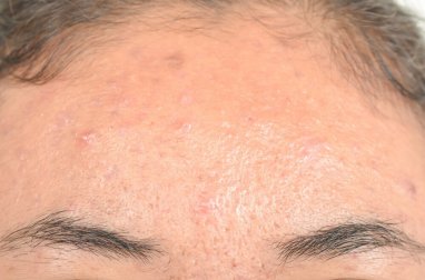 Effektive Naturheilmittel gegen das seborrhoische Ekzem