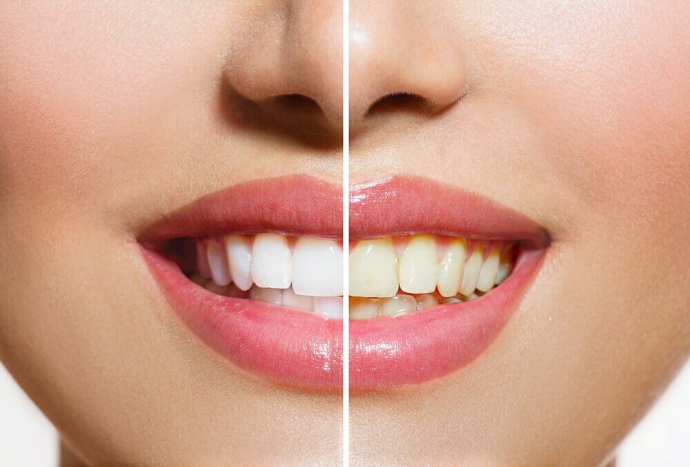Natürliche Produkte für weißere Zähne