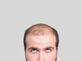 3 Hausmittel gegen Haarverlust