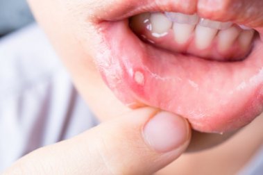 7 Hausmittel gegen Mundgeschwüre