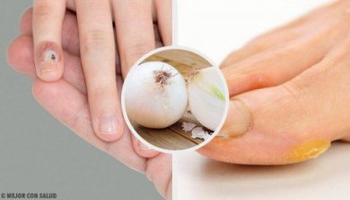 7 natürliche Hausmittel gegen Schwielen