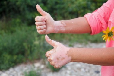 Richtige Ernährung bei Autoimmunkrankheiten