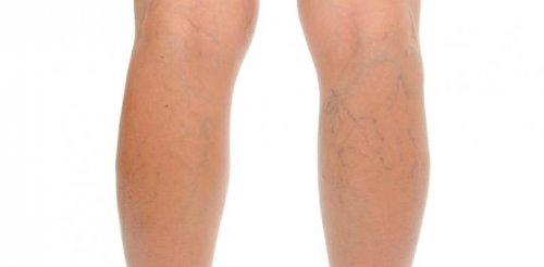 Symptome und effektive Hausmittel zur Entfernung von Celluliten
