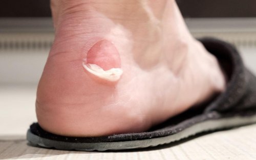 Wie du Blasen vermeiden und dafür sorgen kannst, dass deine Schuhe bequemer werden
