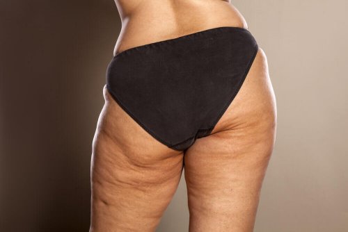 Hausmittel zur Entfernung von Cellulite