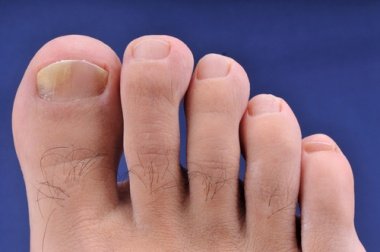 Flip-Flops und Hautkrankheiten