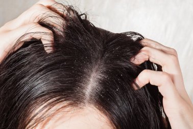 6 effektive Heilmittel gegen Kopfpilz