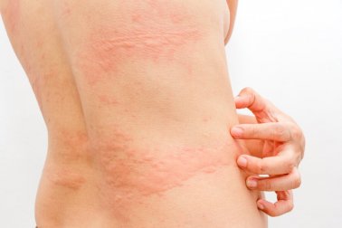 3 natürliche Mittel zur Beruhigung von Nesselsucht