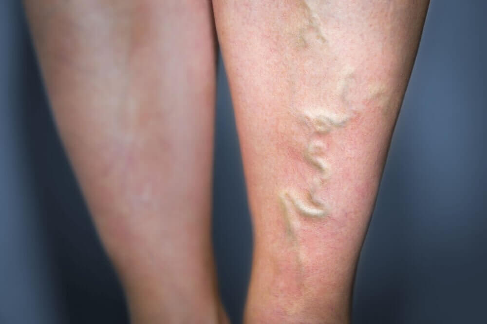 5 natürliche Heilmittel zur Behandlung von Phlebitis 5 natürliche Heilmittel zur Behandlung von Phlebitis