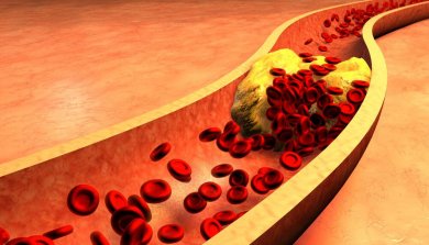 Kanariengras zur Reinigung der Arterien