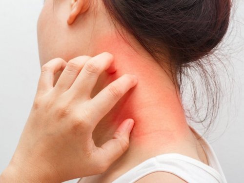 Schwarzkümmel kann Dermatitis verursachen
