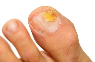 Welche Naturheilmittel gegen Nagelpilz helfen