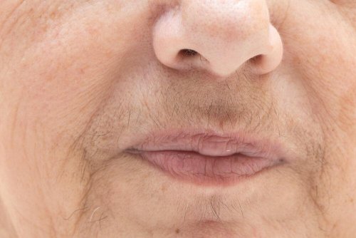 Ursachen für Hirsutismus sind hormonell