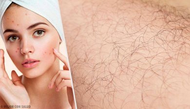 Ursachen für Hirsutismus und Behandlungsmöglichkeiten
