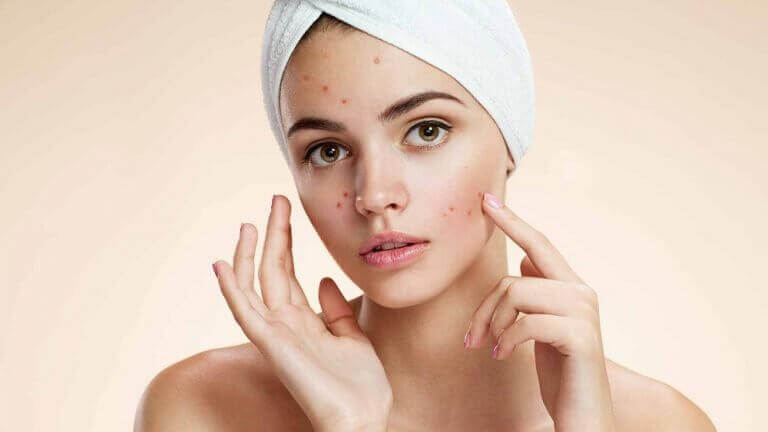 Die häufigsten Hautprobleme: Akne