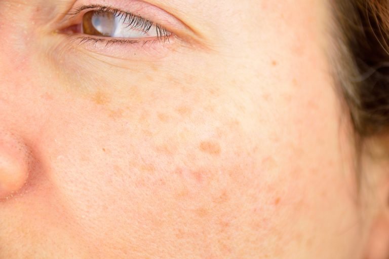 Die häufigsten Hautprobleme: Dunkle Flecken
