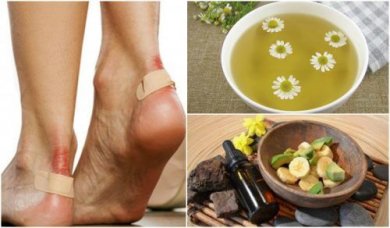 Blasen an den Füßen: 5 natürliche Mittel
