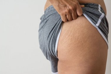 Kokosöl gegen Dehnungsstreifen und Narben
