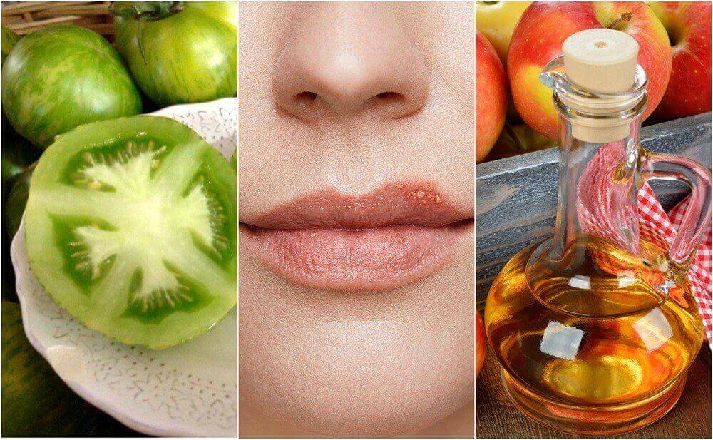 5 natürliche Heilmittel gegen Lippenherpes