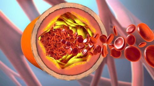 Nie mehr verstopfte Blutgefäße, versuche dieses natürliche Heilmittel aus Zimt und Kanariengras zur Reinigung der Arterien.