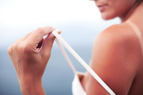 Sonnenbrand heilen: 5 natürliche Hausmittel