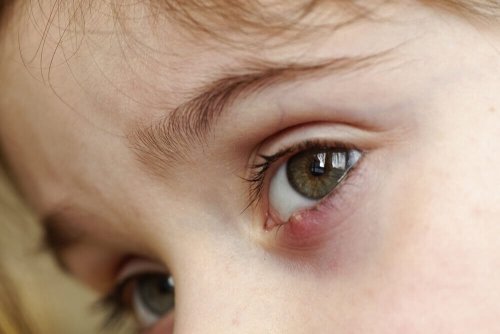 Behandlung von Gerstenkörnern bei einer Frau